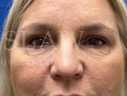 Upper Blepharoplasty Before & After Patient #1557
