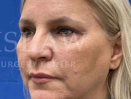 Upper Blepharoplasty Before & After Patient #1557