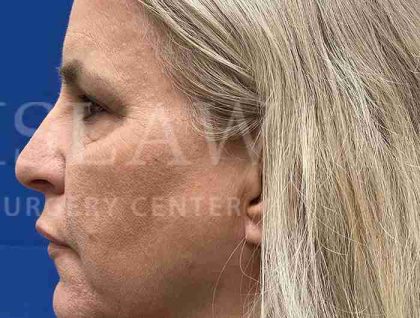 Upper Blepharoplasty Before & After Patient #1557