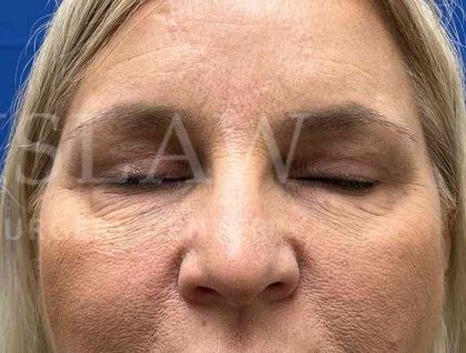 Upper Blepharoplasty Before & After Patient #1557