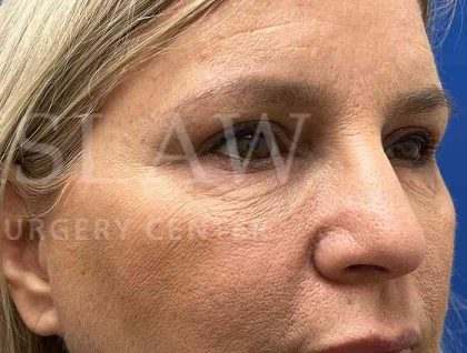 Upper Blepharoplasty Before & After Patient #1557
