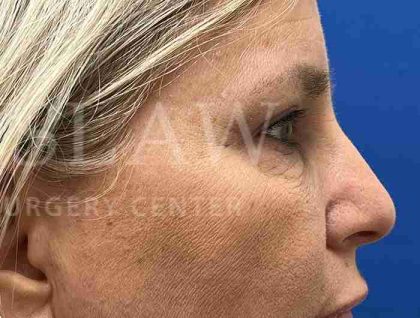 Upper Blepharoplasty Before & After Patient #1557