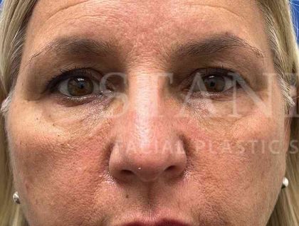 Upper Blepharoplasty Before & After Patient #1557