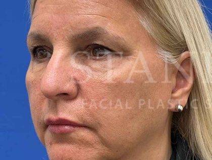 Upper Blepharoplasty Before & After Patient #1557