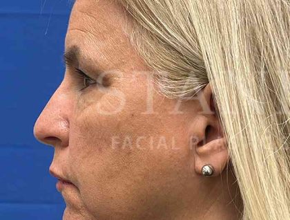 Upper Blepharoplasty Before & After Patient #1557