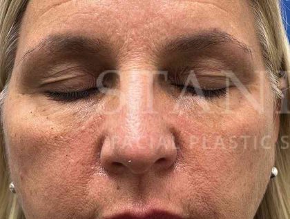 Upper Blepharoplasty Before & After Patient #1557