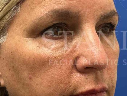Upper Blepharoplasty Before & After Patient #1557