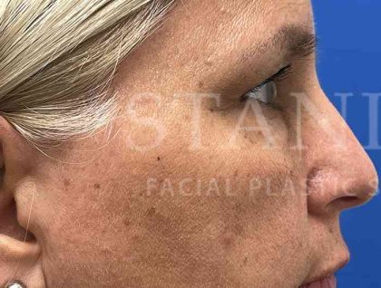 Upper Blepharoplasty Before & After Patient #1557