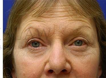 Upper Blepharoplasty Before & After Patient #1597