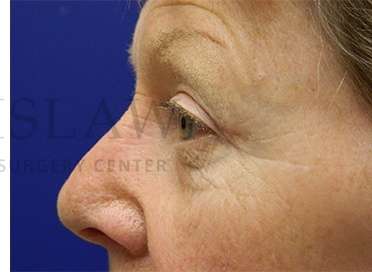 Upper Blepharoplasty Before & After Patient #1597
