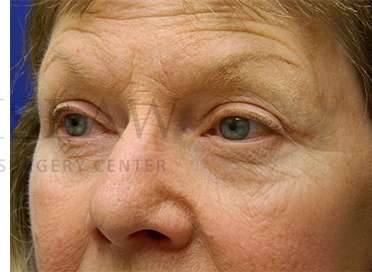 Upper Blepharoplasty Before & After Patient #1597