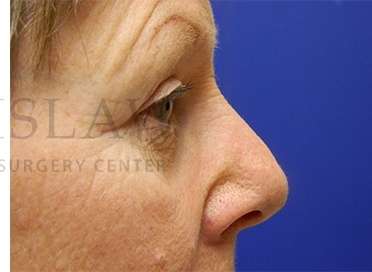 Upper Blepharoplasty Before & After Patient #1597