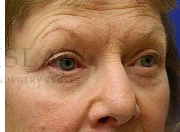 Upper Blepharoplasty Before & After Patient #1597