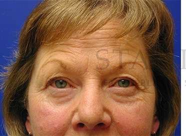 Upper Blepharoplasty Before & After Patient #1597