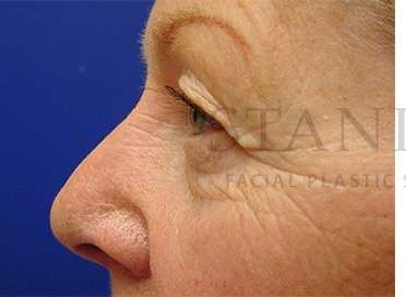 Upper Blepharoplasty Before & After Patient #1597