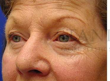 Upper Blepharoplasty Before & After Patient #1597
