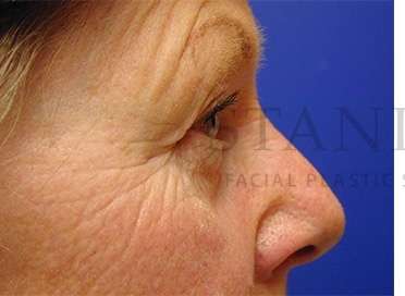 Upper Blepharoplasty Before & After Patient #1597