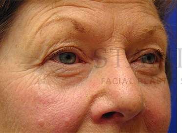 Upper Blepharoplasty Before & After Patient #1597