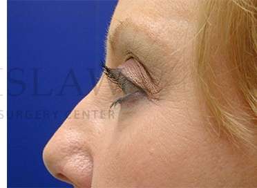 Upper Blepharoplasty Before & After Patient #1575