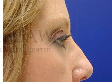 Upper Blepharoplasty Before & After Patient #1575