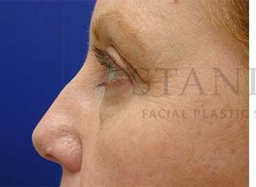 Upper Blepharoplasty Before & After Patient #1575