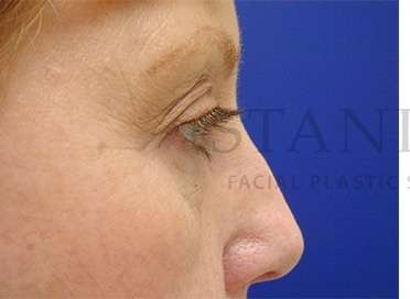 Upper Blepharoplasty Before & After Patient #1575