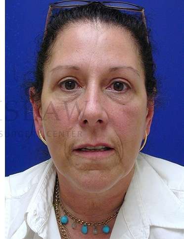 Upper Blepharoplasty Before & After Patient #1570