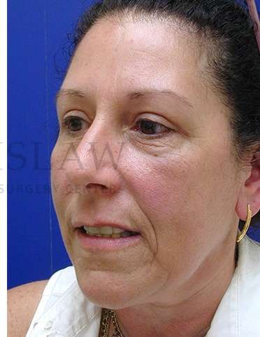 Upper Blepharoplasty Before & After Patient #1570
