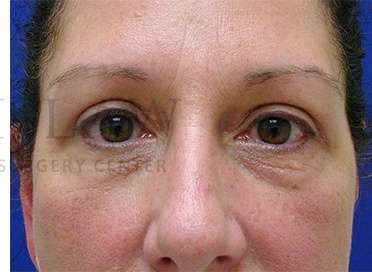 Upper Blepharoplasty Before & After Patient #1570