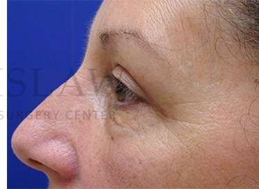 Upper Blepharoplasty Before & After Patient #1570
