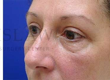 Upper Blepharoplasty Before & After Patient #1570