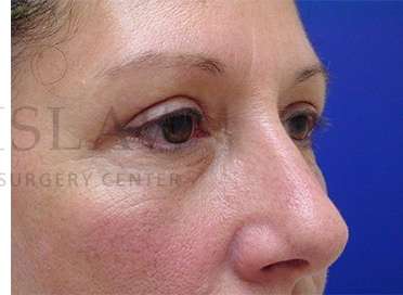 Upper Blepharoplasty Before & After Patient #1570