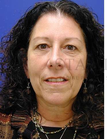 Upper Blepharoplasty Before & After Patient #1570