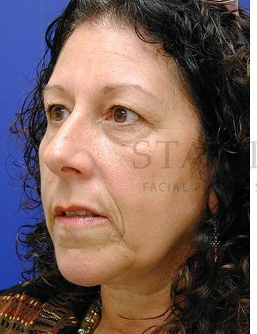 Upper Blepharoplasty Before & After Patient #1570