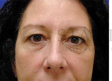 Upper Blepharoplasty Before & After Patient #1570