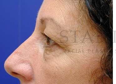 Upper Blepharoplasty Before & After Patient #1570