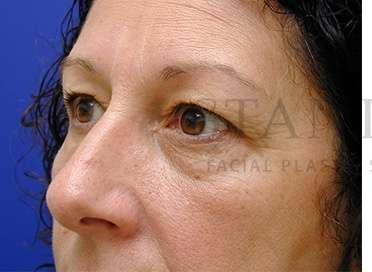 Upper Blepharoplasty Before & After Patient #1570