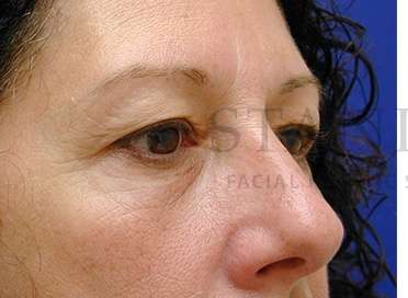 Upper Blepharoplasty Before & After Patient #1570