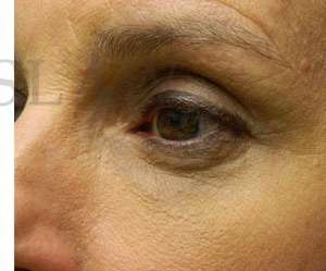 Upper Blepharoplasty Before & After Patient #1586