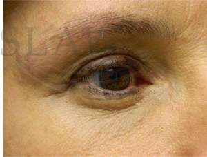 Upper Blepharoplasty Before & After Patient #1586