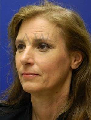 Upper Blepharoplasty Before & After Patient #1586