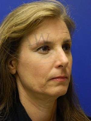 Upper Blepharoplasty Before & After Patient #1586
