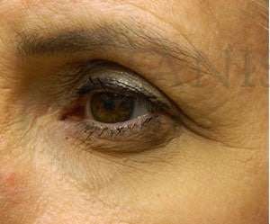 Upper Blepharoplasty Before & After Patient #1586