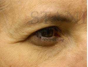 Upper Blepharoplasty Before & After Patient #1586
