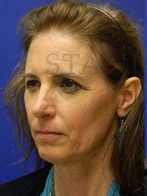 Upper Blepharoplasty Before & After Patient #1586