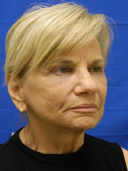 Makeover Before & After Patient #7964