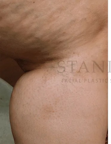 Vascular Reduction Before & After Patient #7903