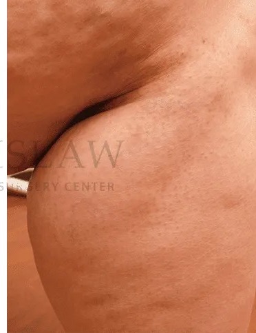Vascular Reduction Before & After Patient #7903