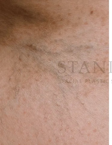 Vascular Reduction Before & After Patient #7903