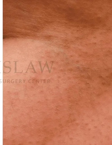 Vascular Reduction Before & After Patient #7903